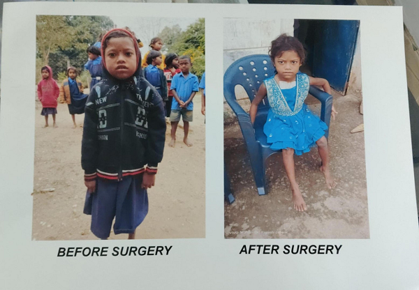 हृदय रोग से पीड़ित दिव्या ऑपरेशन के बाद जी रही है सामान्य जीवन चिरायु योजना बनी वरदान  