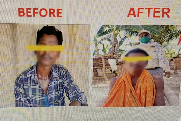  कुष्ठ रोग का समय पर इलाज से सामान्य जीवन जी रहे