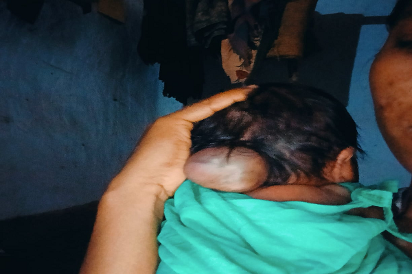  पांच माह की अनुष्का को मिला नया जीवन, चिरायु योजना से संभव हुई सफल सर्जरी