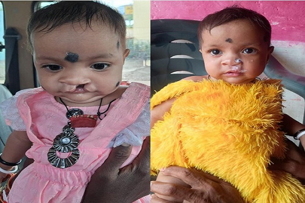 चिरायु योजना बनी बच्चों के लिए जीवनदायिनी