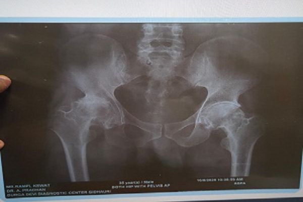 सिम्स में हुआ मरीज का सफल कूल्हा प्रत्यारोपण