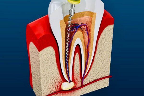 जिला अस्पताल में निःशुल्क रूट कैनाल की सुविधा उपलब्ध