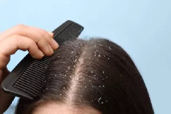सर्दियों में बढ़ गई है बालों में रूसी की समस्या तो आजमाएं ये उपाय...