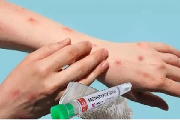 आइसोलेटेड मरीज में पश्चिम अफ़्रीकी क्लैड 2 के एमपॉक्स वायरस की पुष्टि